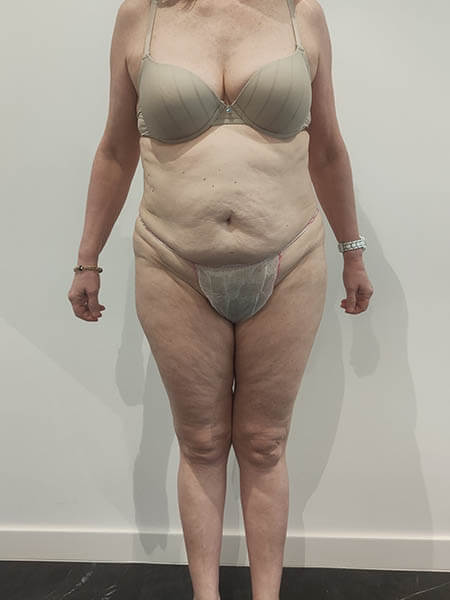 Patrizia dopo il trattamento di criolipolisi